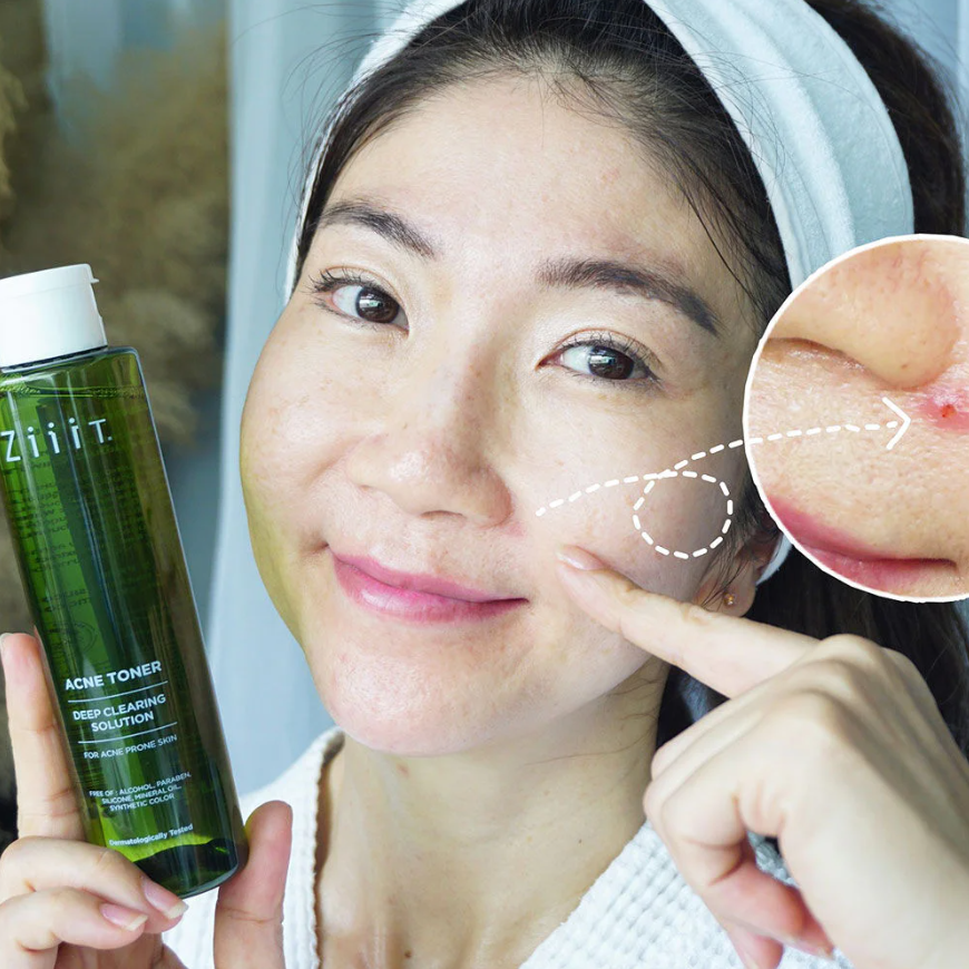 Ziiit - Acne Toner 100ml.