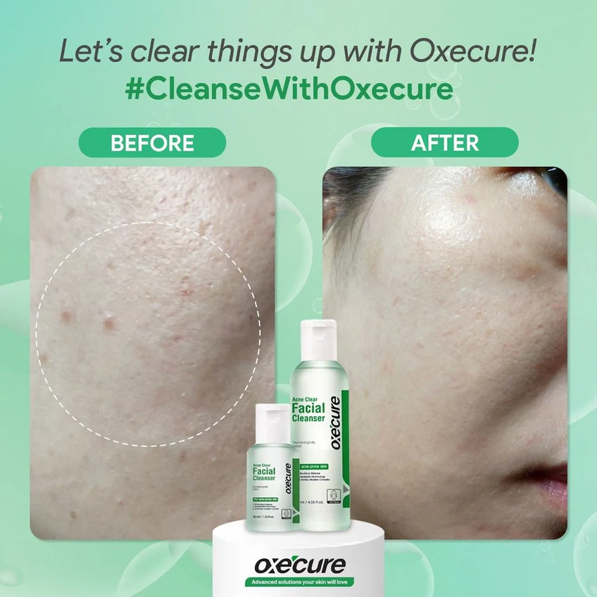 Oxe Cure - Acne Clear Facial Cleanser 120ml.