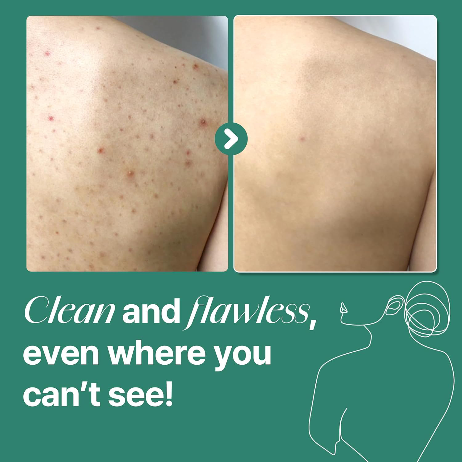 SOME BY MI - AHA-BHA-PHA 30 Days Miracle Acne Clear Body Cleanser 400g.