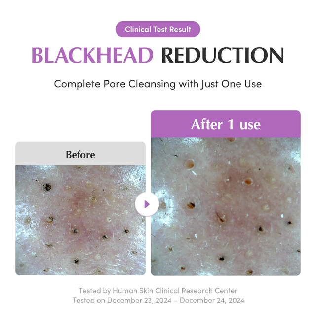 EQQUALBERRY - Bundle of: 1x Purple Rice Pore Purifying Pack Cleanser 130g. + 1x Purple PDRN Pore Minimizing Serum 30ml.