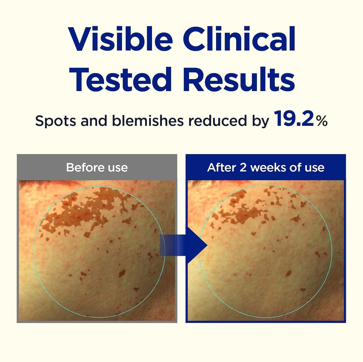 CKD GUARANTEED - Vita C Teca Triple Blemish Patch 82g. (60 Patches)