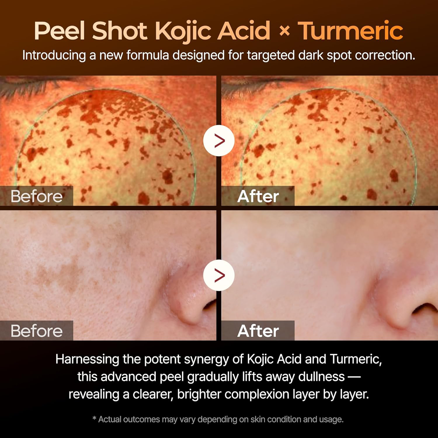 Dr.Melaxin - Peel Shot Exfoliating Kojic Acid Turmeric Serum with Glycolic Acid 80ml.