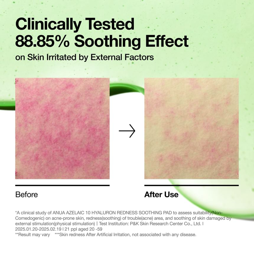 Anua - Bundle of: 1x Azelaic 10 Hyaluron Redness Soothing Pad (90 Pads) + 1x Azelaic Acid 10 Hyaluron Redness Soothing Serum 30ml.