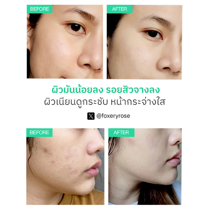 Nu Formula - Pore Deep Clarifying Foam Acne Solution 150g.